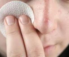 顔面のにきびの原因とそれらを取り除く方法